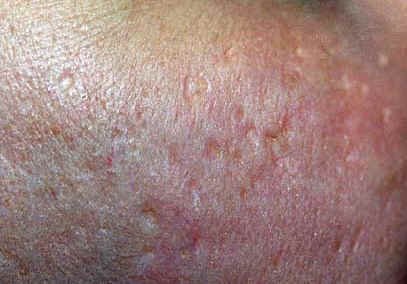 acnescar.jpg (15274 bytes)