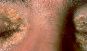 xanthelasma pic 1
