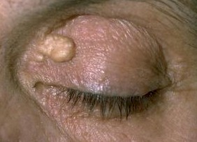 xanthelasma 2