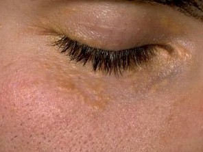 xanthelasma pic 3